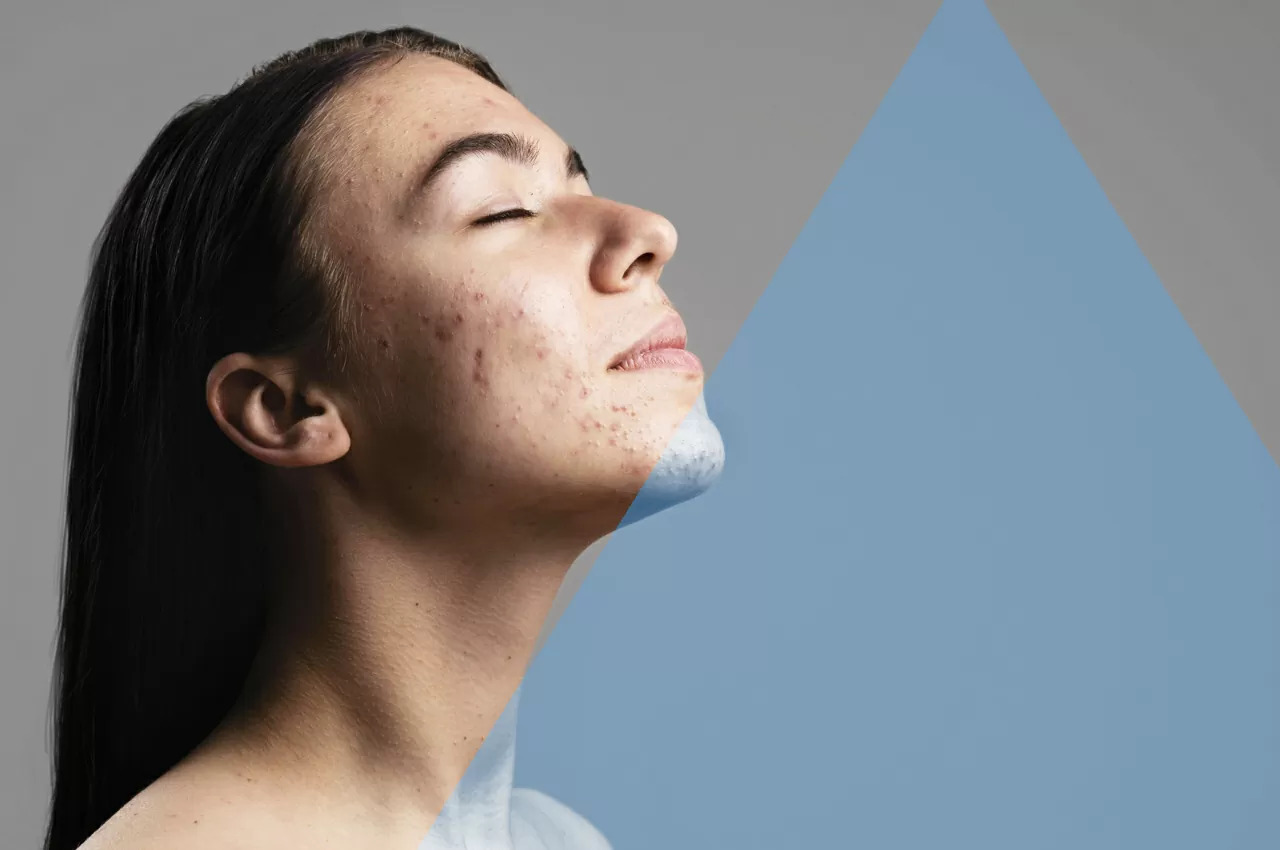 Il sole fa bene o male all'Acne?