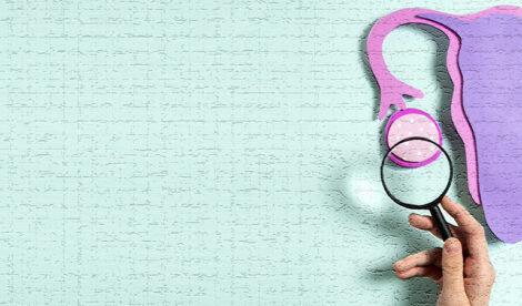 PCOS, PMOS, Sindrome dell'Ovaio Policistico